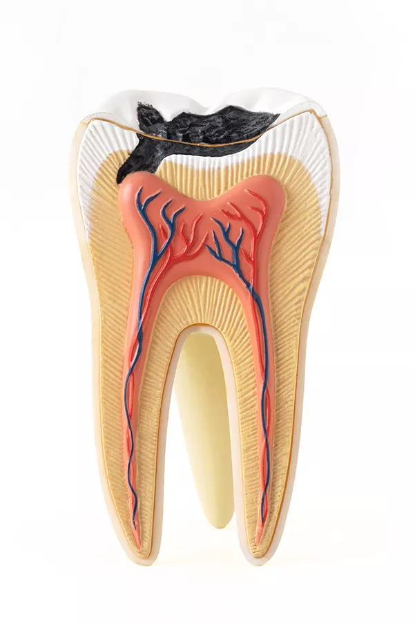Modelo de estructura dental interna con destrucción de caries